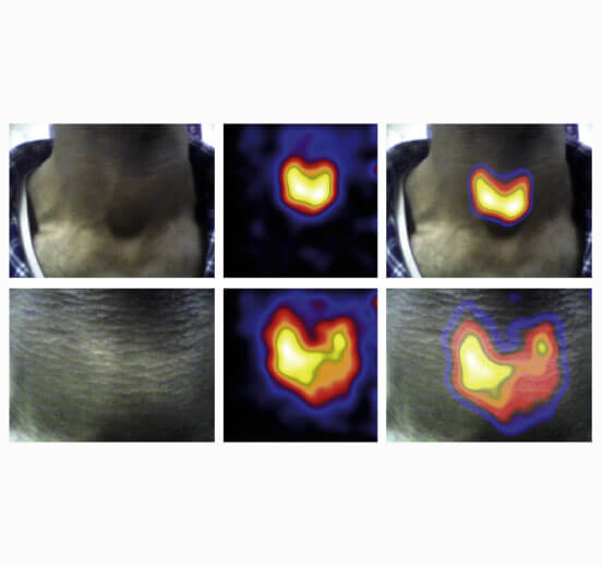 Thyroid imaging using Hybrid Gamma Camera